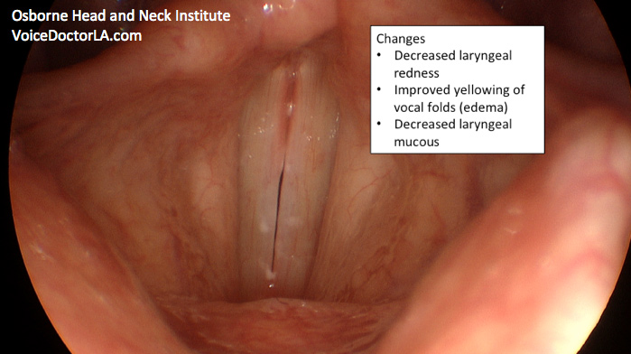 reflux-treatment