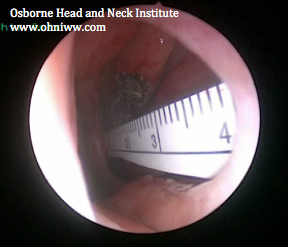 Figure 2: Nasal septum perforation. A ruler has been inserted into the opposite nostril to demonstrate scale.