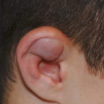 Boxer’s Ear: Can your ear explode?