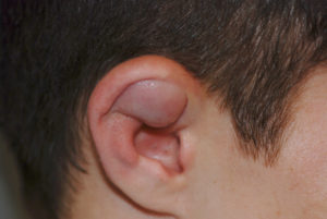 Read more about the article Boxer’s Ear: Can your ear explode?