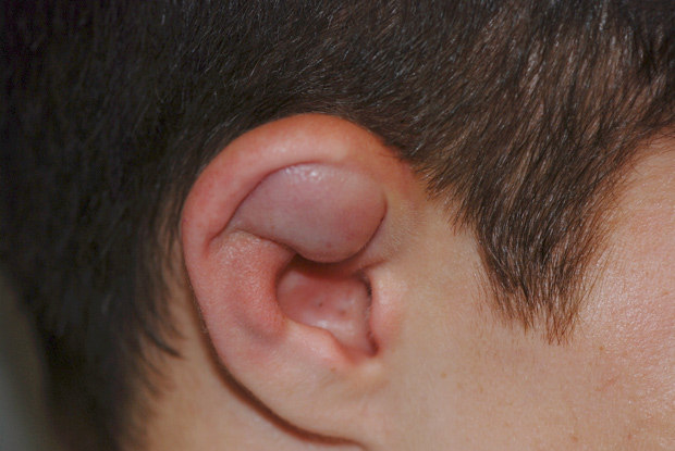 Figure 2: Right auricular hematoma.
