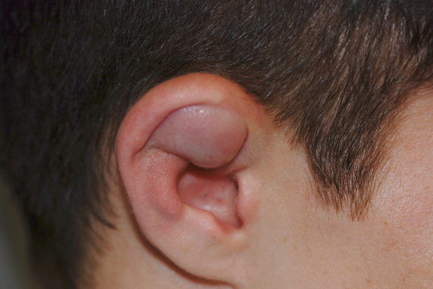 Figura 2: Hematoma auricular derecho.