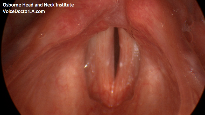 effects of alcohol on vocal cords