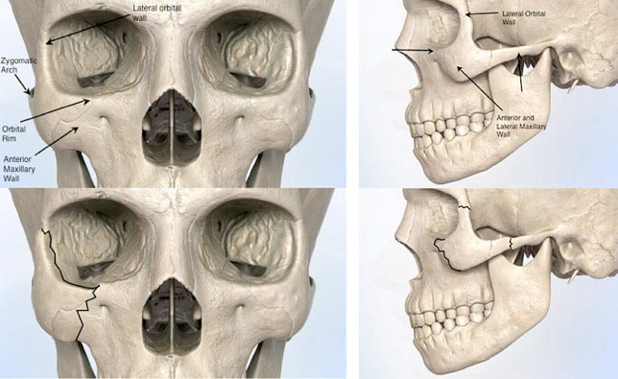 Figure 2: Schematic of structures comprising the cheekbone area (top). Areas commonly fractured during a cheekbone fracture (bottom).