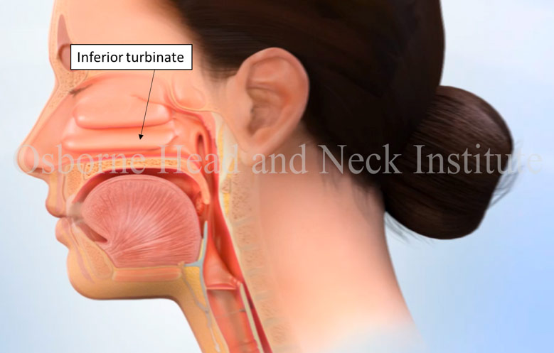 allergic-laryngitis