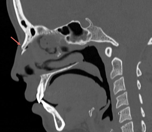 Figure 1: Sagittal CT of the face before closed nasal reduction showing the fractured nasal bones.