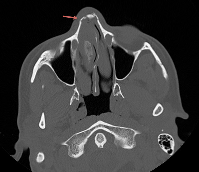 Figure 2: Axial CT of the face before closed nasal reduction showing the fractured nasal bones.