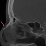 What is the Best Imaging Study to Evaluate a Broken Nose?