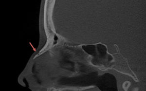 Read more about the article What is the Best Imaging Study to Evaluate a Broken Nose?