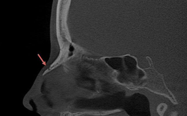 Figure 3: Sagittal CT of the face after closed nasal reduction showing well-aligned nasal bones.