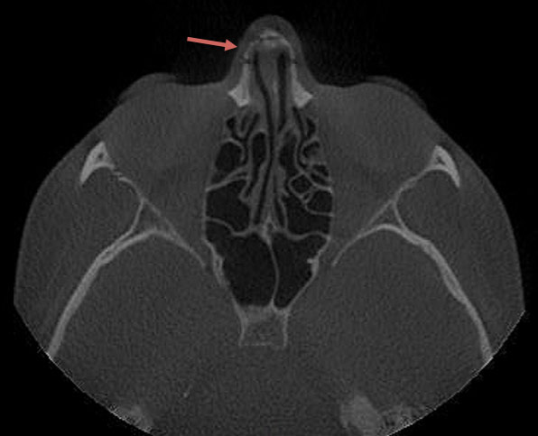 Figure 4: Axial CT of the face after closed nasal fracture showing well-aligned nasal bones.