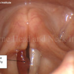 Voice Case of the Week: “Pushing Through” and “Working Around” Hoarseness