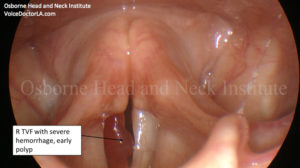 Read more about the article Voice Case of the Week: “Pushing Through” and “Working Around” Hoarseness