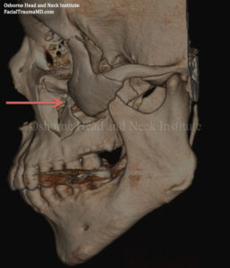 Read more about the article Facial Trauma and Orbital Fracture
