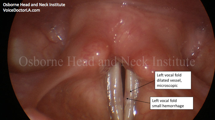 Figure 1: This singer has a very small hemorrhage that she was unaware of. Her only symptom was vocal fatigue and slight increase in effort in the upper part of her head voice.