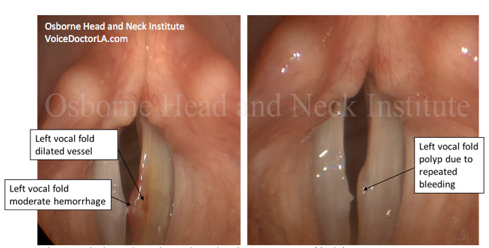 Figure 2: This singer had a moderate hemorrhage that she was unaware of (right). Conservative treatment involved laser treatment of the vessel. However, the injury from repeated hemorrhage had already been done and the resultant polyp is seen (left). 