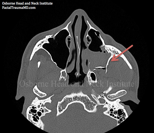 orbital-fracture-treatment