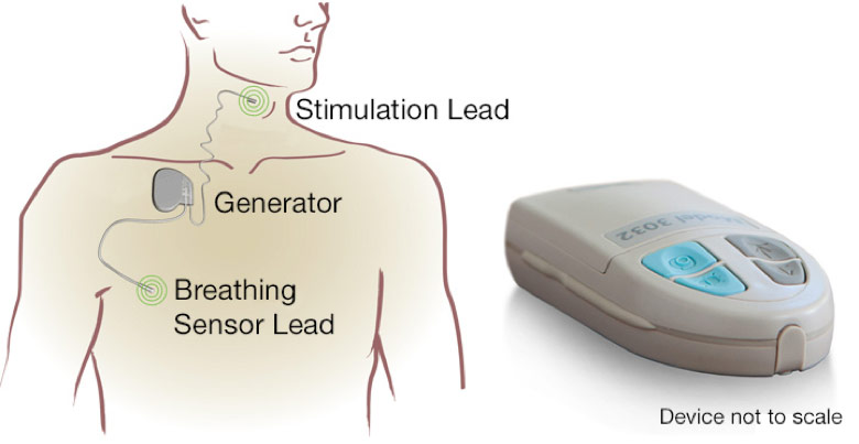 treatment for sleep apnea