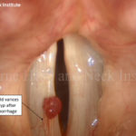 Small Hemorrhages: So Now What?