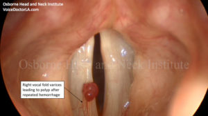 Read more about the article Small Hemorrhages: So Now What?
