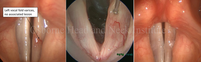 Figure: This opera singer noted vocal fatigue. Screening stroboscopy demonstrated a varix that had not formed a lesion but was very dilated. We opted for preventative laser treatment. Two weeks later, the vessel is gone and fatigue is resolved.