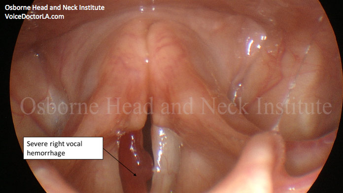 vocal-hemorrhage-treatment