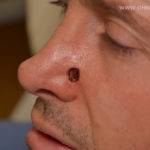Basal Cell Carcinoma of the Nose and Nasal Reconstruction