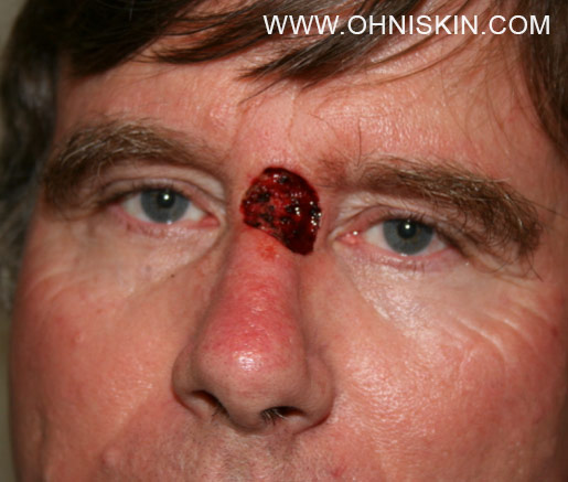 Figure 1: Patient with partial removal of tumor after Mohs Surgery