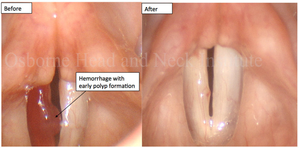 hemorrhage-polyp-2