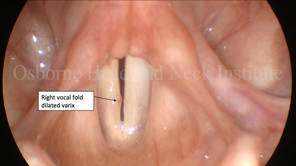 hemorrhage-polyp-3