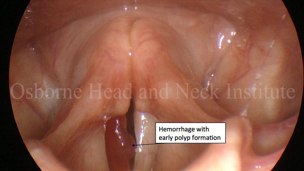 hemorrhage-polyp