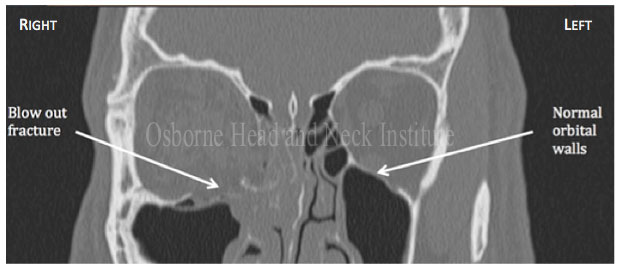 Figure 2: CT image of the head depicting an orbital fracture (right) and normal orbit (left).