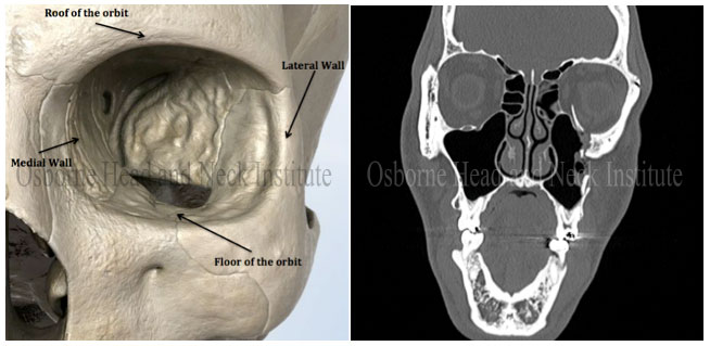 Figure 2: Schematic of the orbit demonstrating its four bony walls (left). CT of the skull demonstrating a left orbital fracture (right).