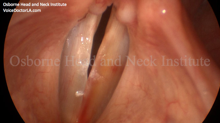Image: Small hemorrhages like the one seen here can result in significant injury. However, this may be undetectable to the singer due to the slight hoarseness it causes, and they may “push through” this. Only videostroboscopy with a laryngologist can detect this.