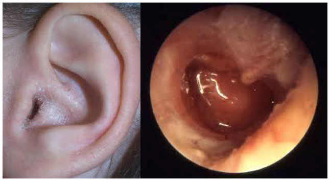 Figure 2: Photograph of the external ear demonstrating crusting and flaking at the entrance of the external ear canal (left). Otoscopic examination of the external ear canal demonstrating redness and swelling consistent with otitis externa (right).