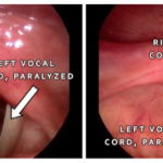 What is Vocal Cord Paralysis?