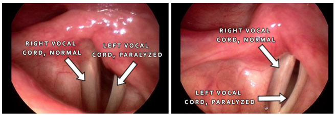 Figure: Videostroboscopy image demonstrating left vocal cord paralysis.