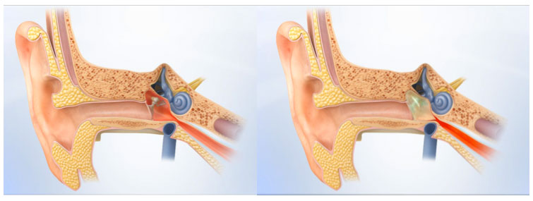Figure 1: Normal Ear- This ear is in a healthy state with no abnormalities (left). Otitis Media-The middle ear is filled with fluid that results in trouble hearing, fever, feeling of fullness in the ear, and vertigo (right).