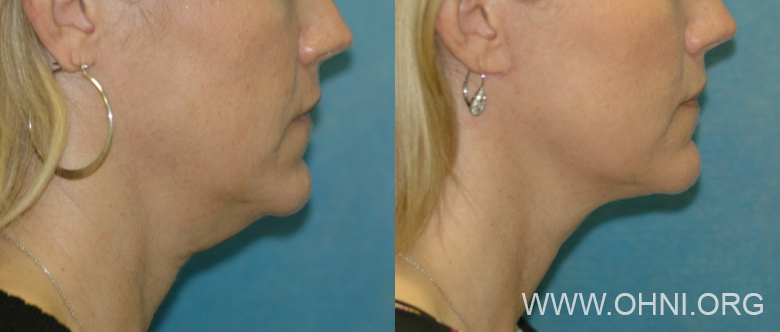 Figure 1: 46-year-old woman prior to surgery (left) and four months after Micro-Mini Lift procedure (right).