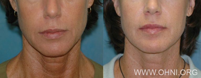 Figure 3: 51-year-old woman prior to surgery (left) and 1 year after Micro-Mini Lift (right).