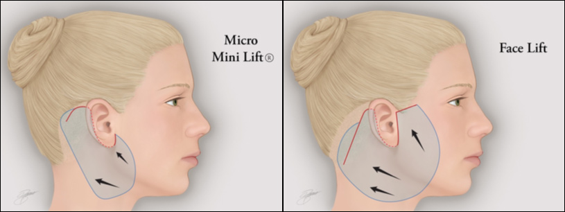 Figure 1: Schematic comparison between micro-mini lift (left) and traditional face lift (left) incisions and areas of elevation.