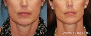 Read more about the article The Micro-Mini Lift®: Minimally Invasive Facelift
