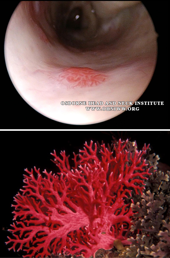 Figure 2: HHT - Nasal Telangiectasia (top). The telangiectasia resembles a red branching coral (bottom), appearing as a slightly raised cluster of dilated capillary vessels surrounded by normal mucosal tissue.
