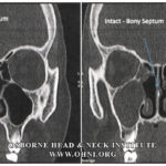 Wegener’s Granulomatosis: Autoimmune Disease and Multi-Focal Septal Perforation