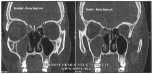 Read more about the article Wegener’s Granulomatosis: Autoimmune Disease and Multi-Focal Septal Perforation