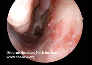 Read more about the article Hereditary Hemorrhagic Telangiectasia