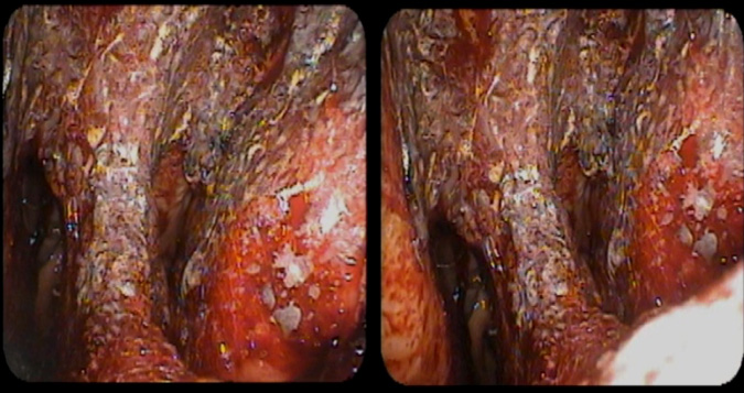Figure 1: Nasal endoscopic view of the nasal passage demonstrating dried blood and scaly skin that would normally be pink and moist.