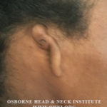 Microtia: Congenital Deformity of the Ear