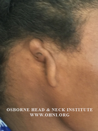 Figure 1: Image of a patient demonstrating Grade III Microtia, the most common form.