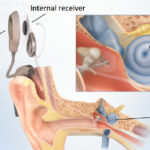 Cochlear Implant: An Overview